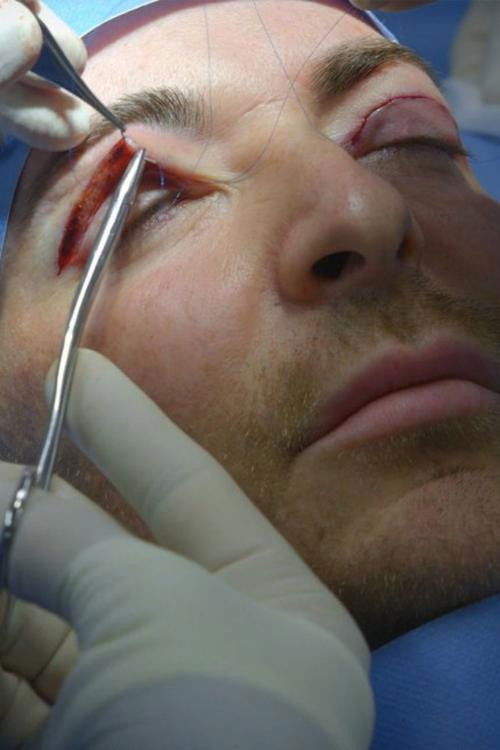 Facelifts and Fillers