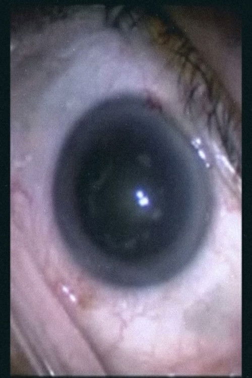 Botched Eyeball Operation